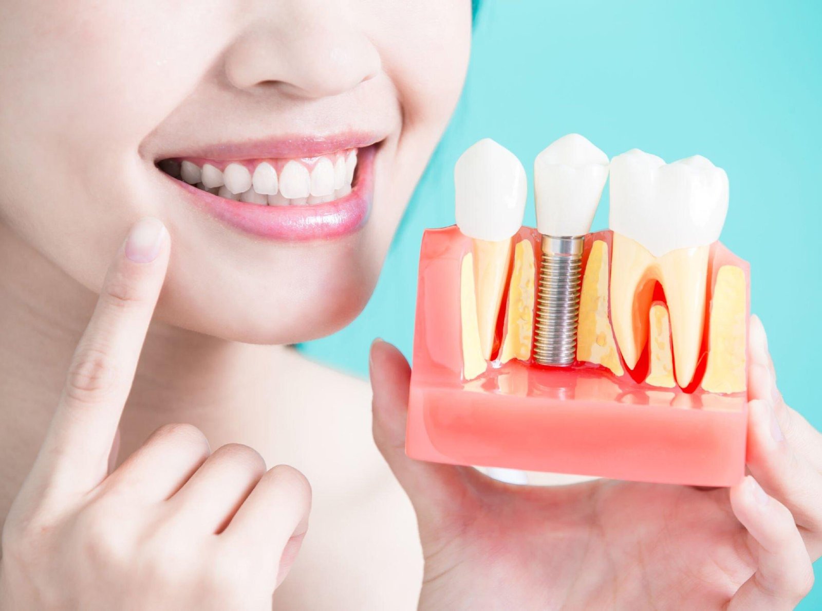 Dental Implants in Nellore