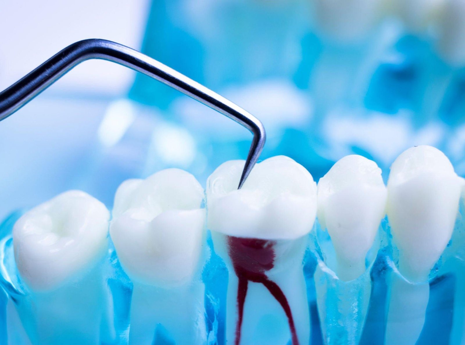 Root canal treatment in nellore