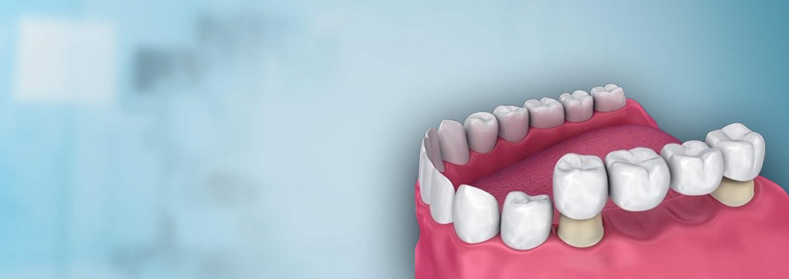 Dental Crowns & Bridges in Nellore