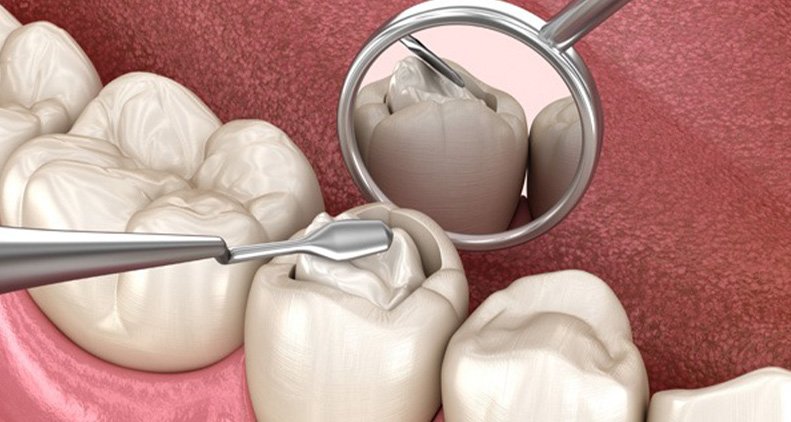 Dental Fillings in Nellore at Dr Rohits Vijaya Dental Clinic
