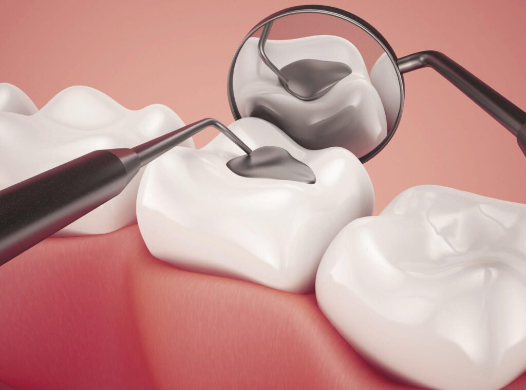 Dental Fillings in Nellore at Dr Rohits Vijaya Dental Clinic